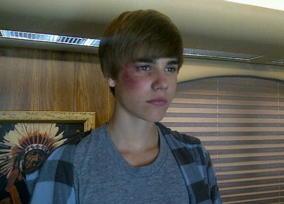 justin bieber eyes. Justin Bieber#39;s black eye for