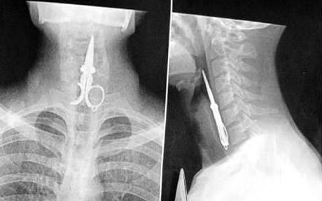 X-ray of man who swallowed scissors