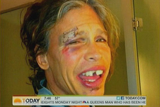 Steven Tyler broken face